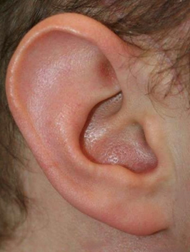 Operación de reducción de orejas